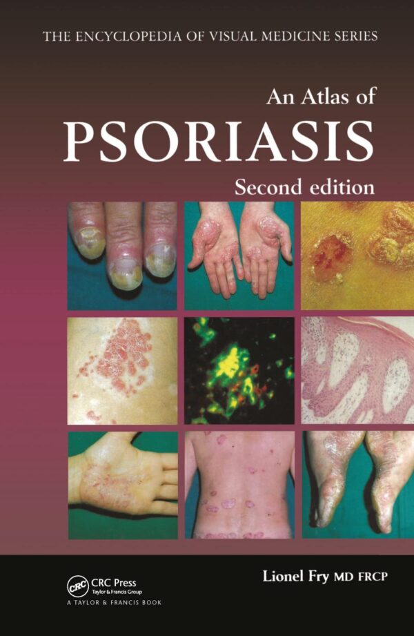 AN ATLAS OF PSORIASIS (ENCYCLOPEDIA OF VISUAL MEDICINE) (ENCYCLOPEDIA OF VISUAL MEDICINE SERIES): 77