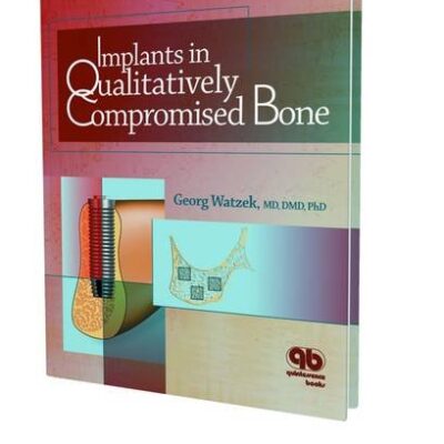 Implants In Qualitatively Compromised Bone (Hb 2004)