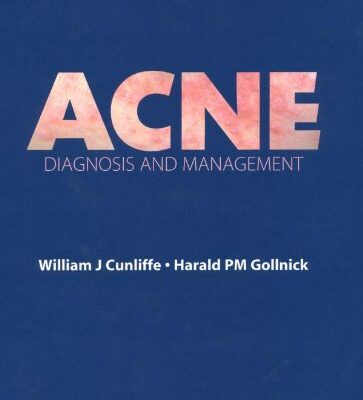 Acne: Diagnosis and Management