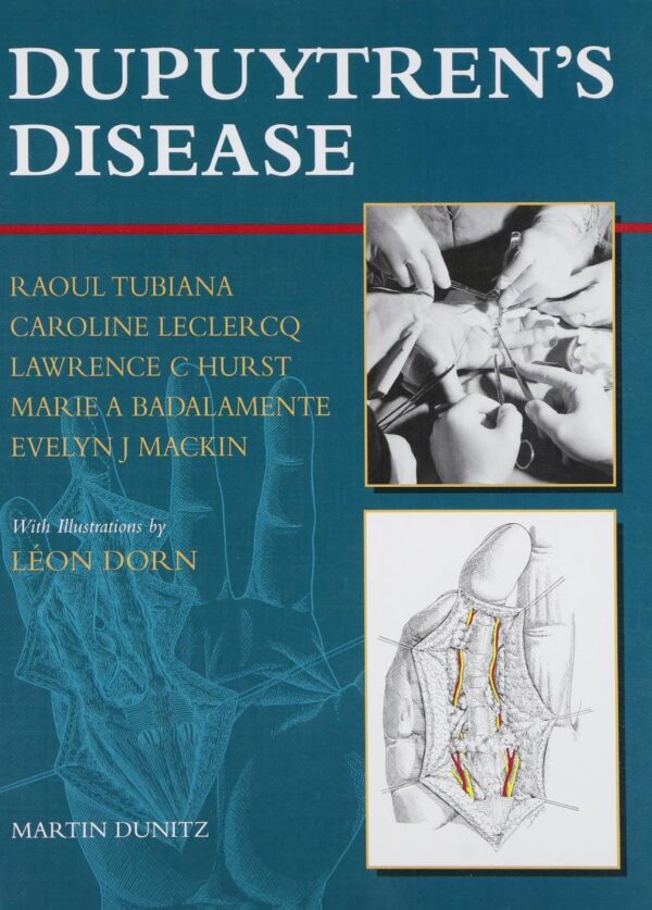 Dupuytren's Disease