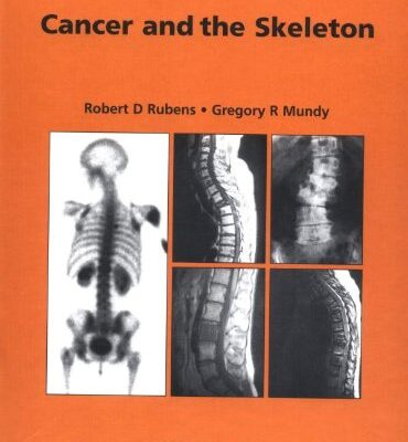 Cancer and the Skeleton