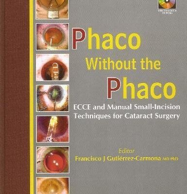 Phaco Without the Phaco: ECCE and Manual Small-Incision Techniques for Cataract Surgery