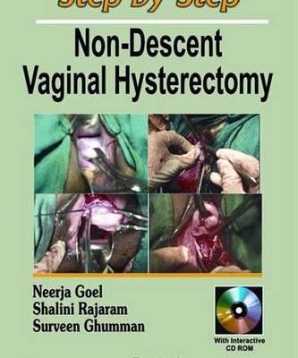 Step by Step Non-Descent Vaginal Hysterectomy