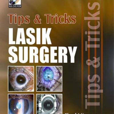Lasik Surgery Tips & Tricks