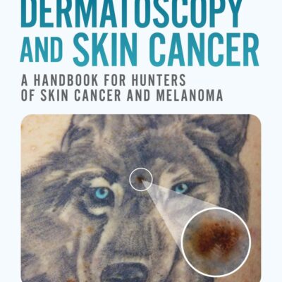 Dermatoscopy and Skin Cancer, second edition: A handbook for hunters of skin cancer and melanoma