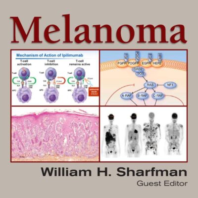 Melanoma