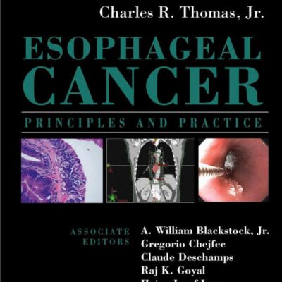 Esophageal Cancer