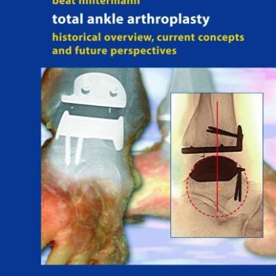 Total Ankle Arthroplasty: Historical Overview, Current Concepts and Future Perspectives