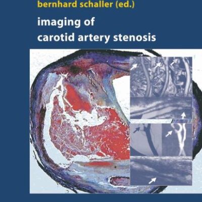 IMAGING OF CAROTID ARTERY STENOSIS