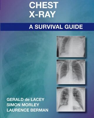 The Chest X-Ray: A Survival Guide
