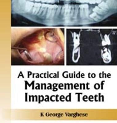 A Practical Guide to the Management of Impacted Teeth
