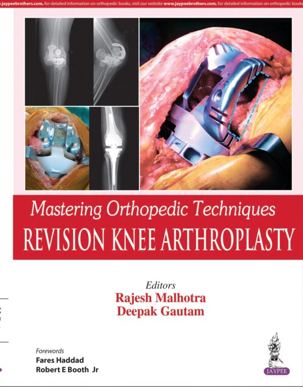 Knee Arthroplasty - Buy Online India